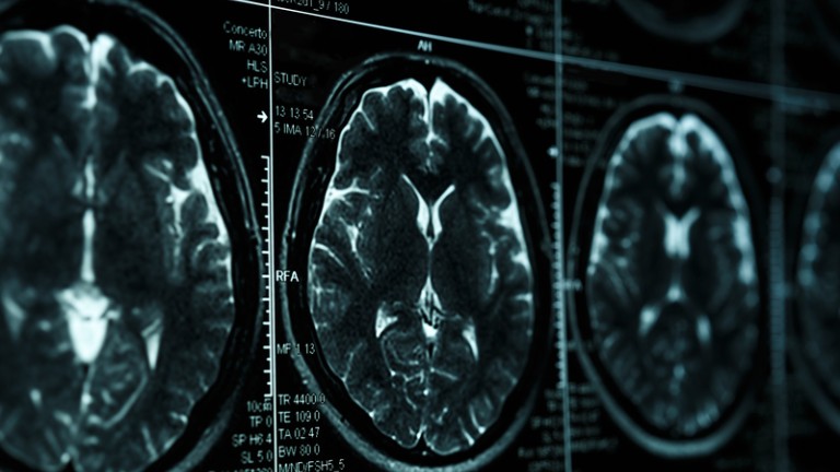 Brain scan imaging