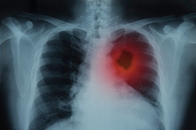 Lungs and lung cancer